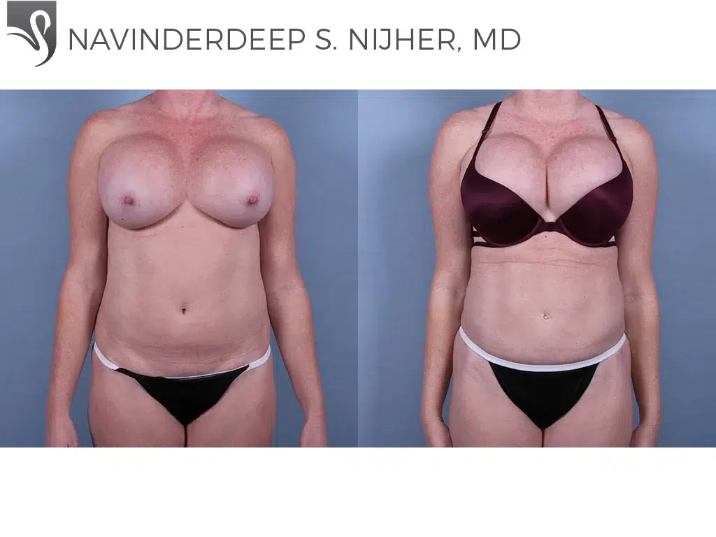 Before and After Image: Liposuction Case #36852