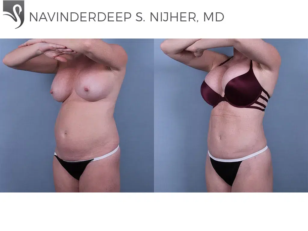 Before and After Image: Liposuction Case #36852 - left-front-oblique