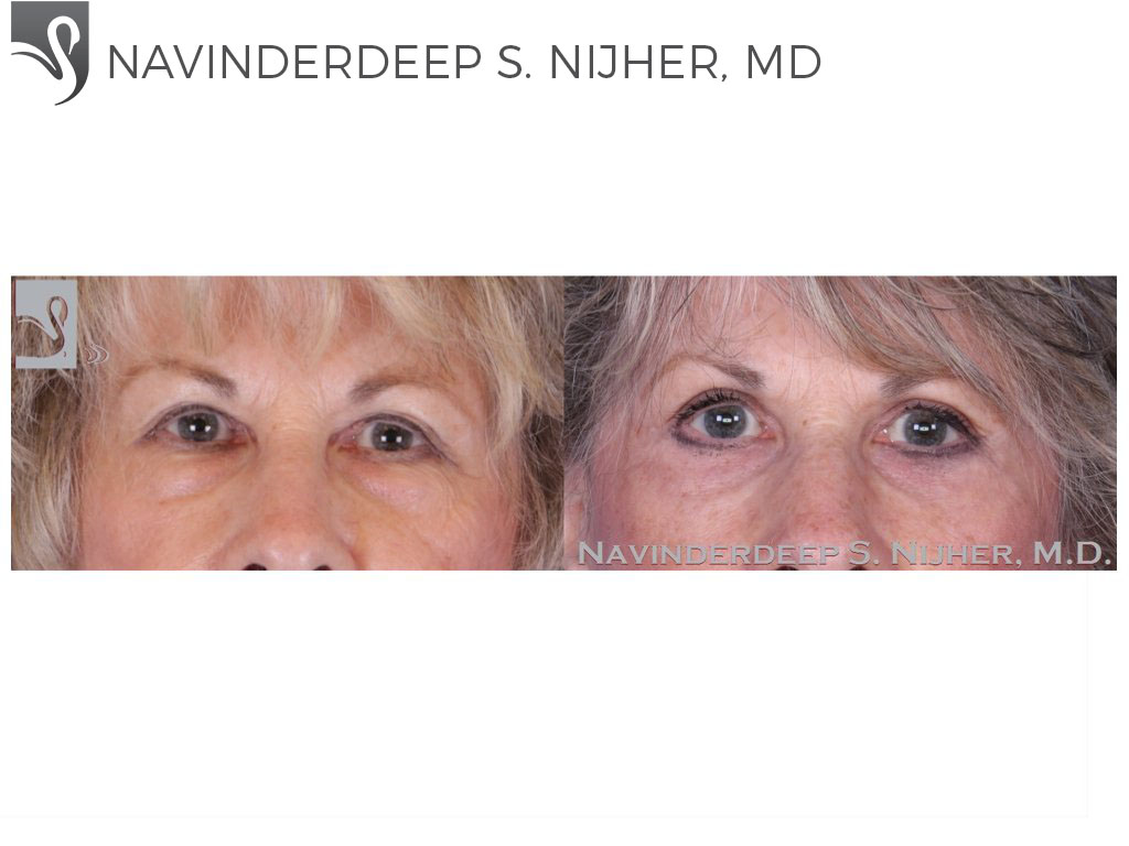 Before and After Image: Eyelid Surgery Case #36941 - front