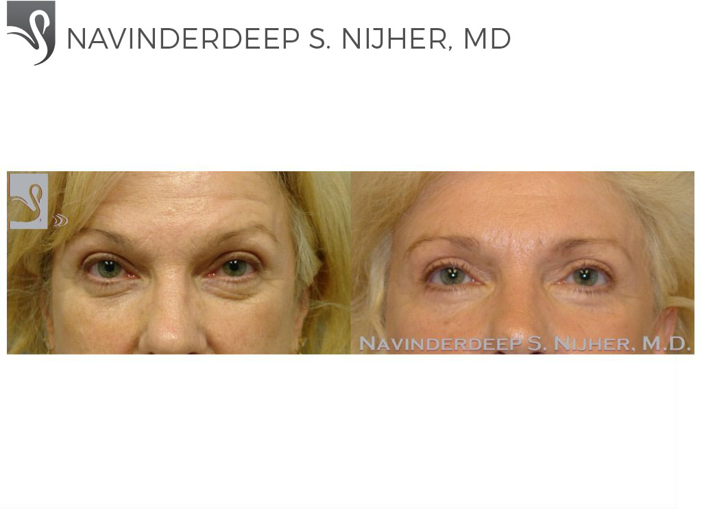 Before and After Image: Eyelid Surgery Case #37215 - front