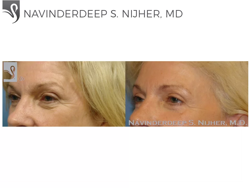 Before and After Image: Eyelid Surgery Case #37215 - left-front-oblique