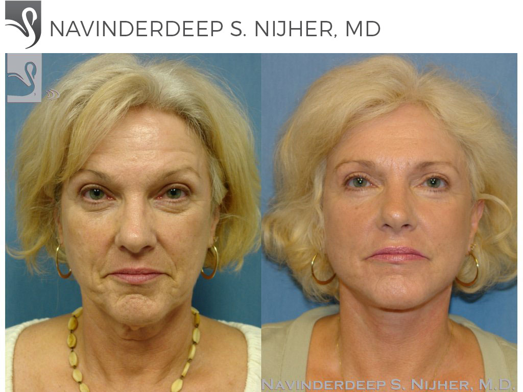 Before and After Image: Face Lift Case #37215 - front