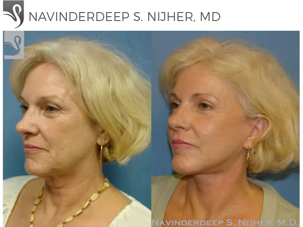 Before and After Image: Face Lift Case #37215 - left-front-oblique