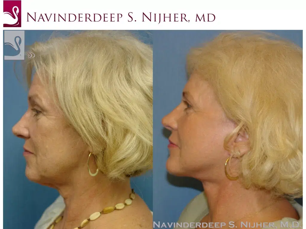 Before and After Image: Face Lift Case #37215 - left-side