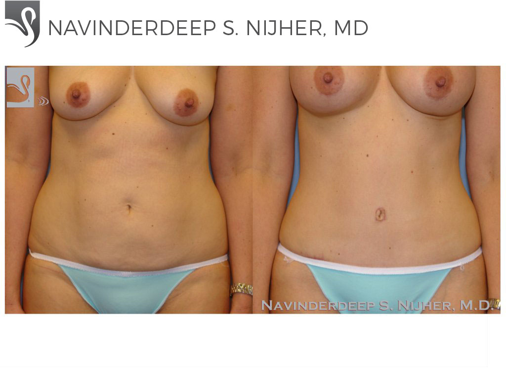 Before and After Image: Abdominoplasty (Tummy Tuck) Case #37824 - front