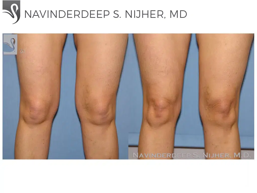 Before and After Image: Liposuction Case #37824