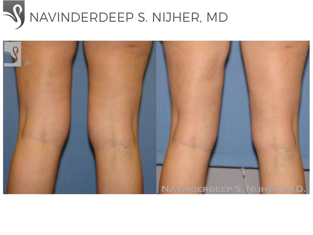 Before and After Image: Liposuction Case #37824 - back
