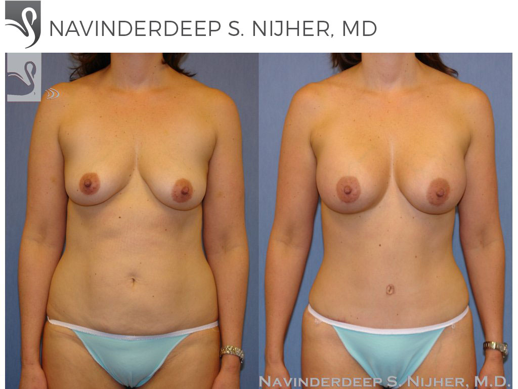 Before and After Image: Mommy Makeover Case #37824 - front