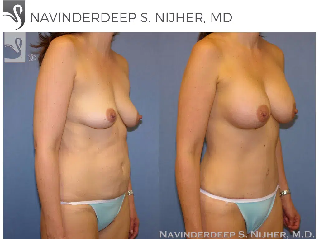 Before and After Image: Mommy Makeover Case #37824 - right-front-oblique
