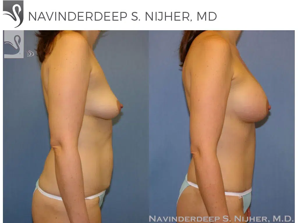 Before and After Image: Mommy Makeover Case #37824 - right-side