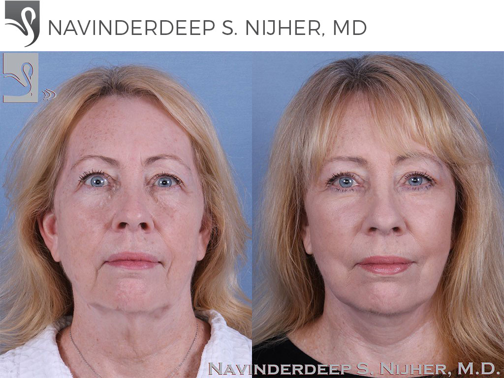Before and After Image: Face Lift Case #37895 - front
