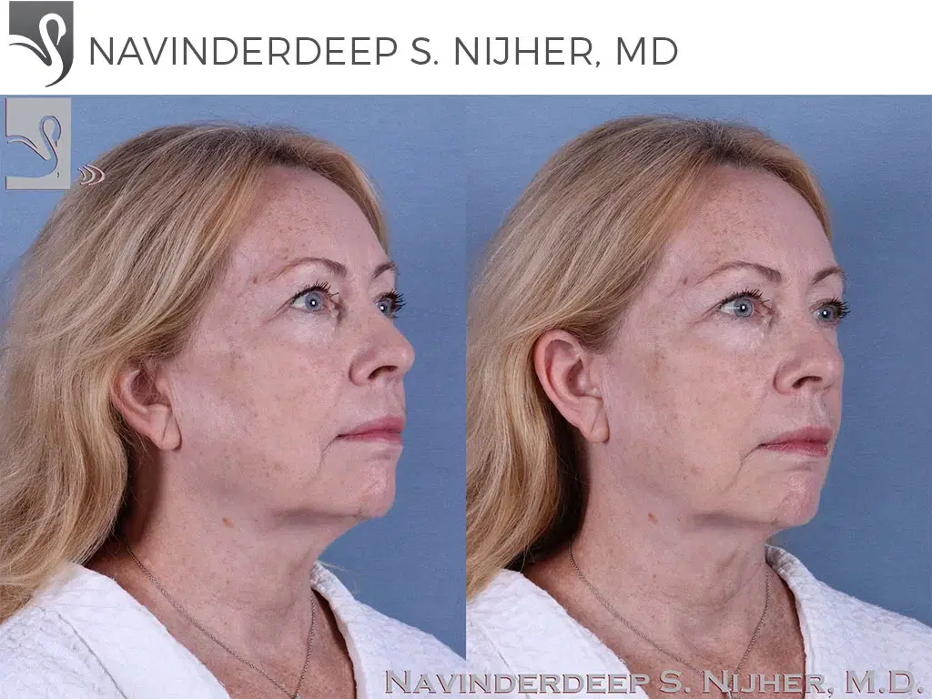 Before and After Image: Face Lift Case #37895 - right-front-oblique