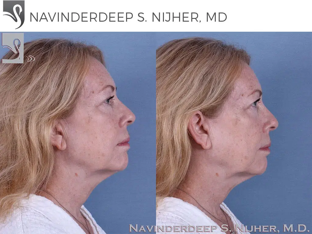 Before and After Image: Face Lift Case #37895 - right-side