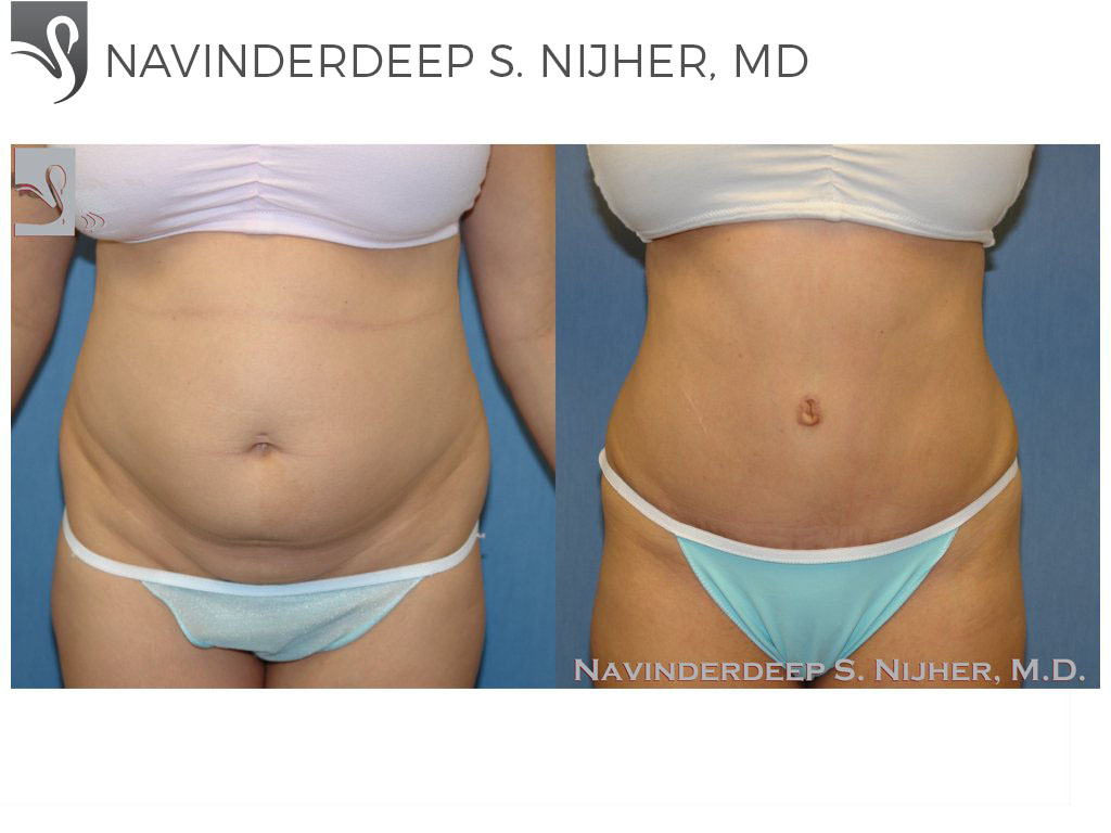 Before and After Image: Abdominoplasty (Tummy Tuck) Case #37974 - front