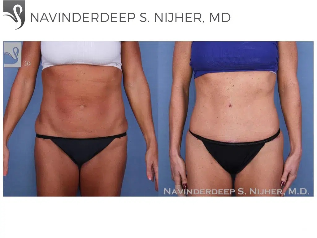 Before and After Image: Liposuction Case #38931 - front