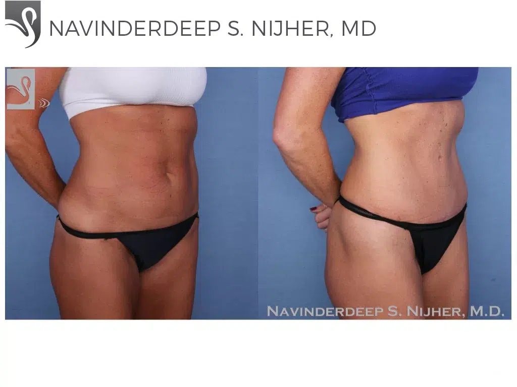 Before and After Image: Liposuction Case #38931 - right-front-oblique