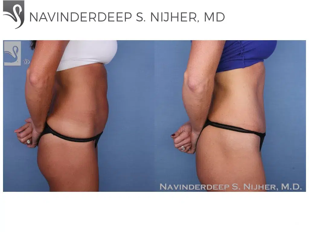 Before and After Image: Liposuction Case #38931 - right-side