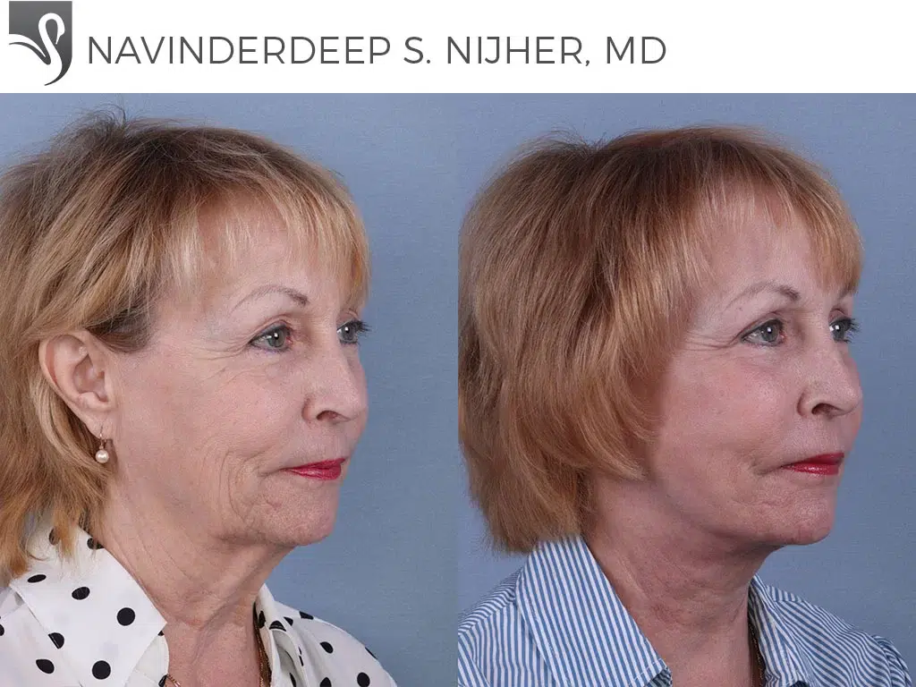 Before and After Image: Face Lift Case #39075 - right-front-oblique