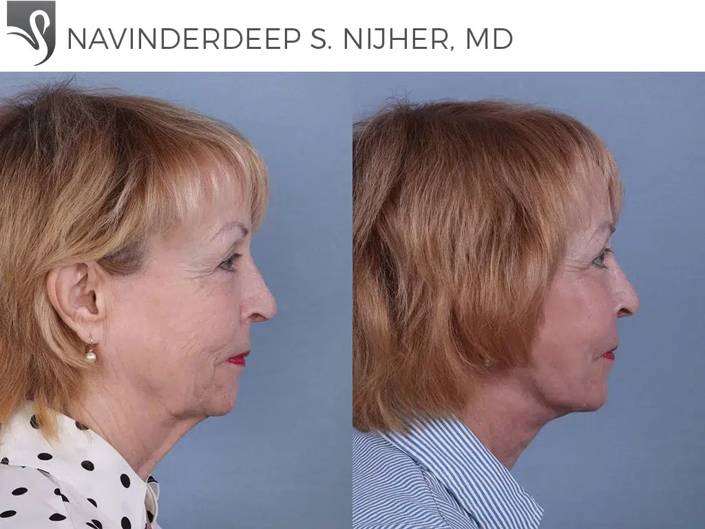 Before and After Image: Face Lift Case #39075 - right-side