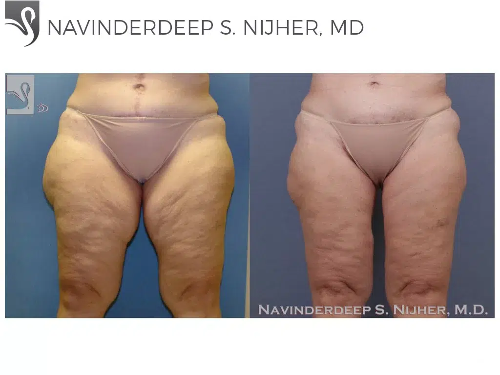 Before and After Image: Body Contouring Case #39168