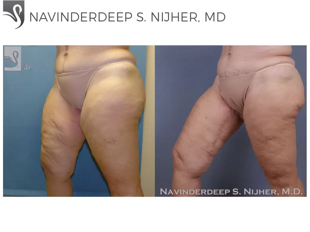 Before and After Image: Body Contouring Case #39168 - left-front-oblique