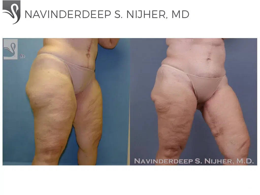 Before and After Image: Thigh Lift Case #39168 - right-front-oblique