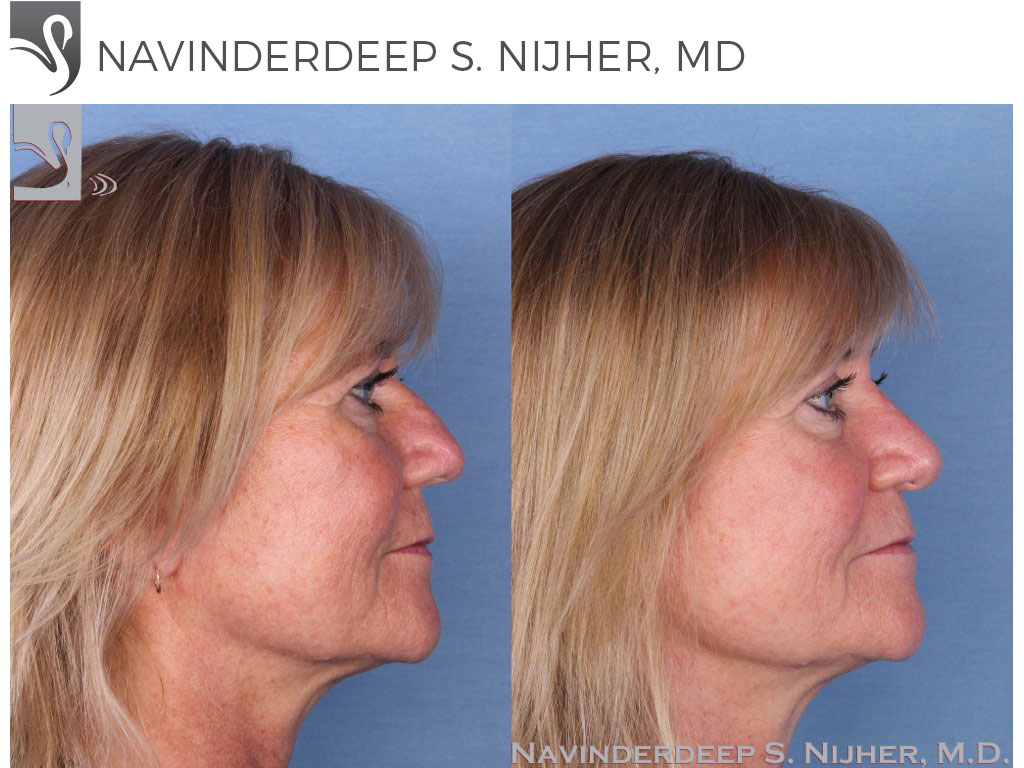 Before and After Image: Rhinoplasty Case #39808 - right-side