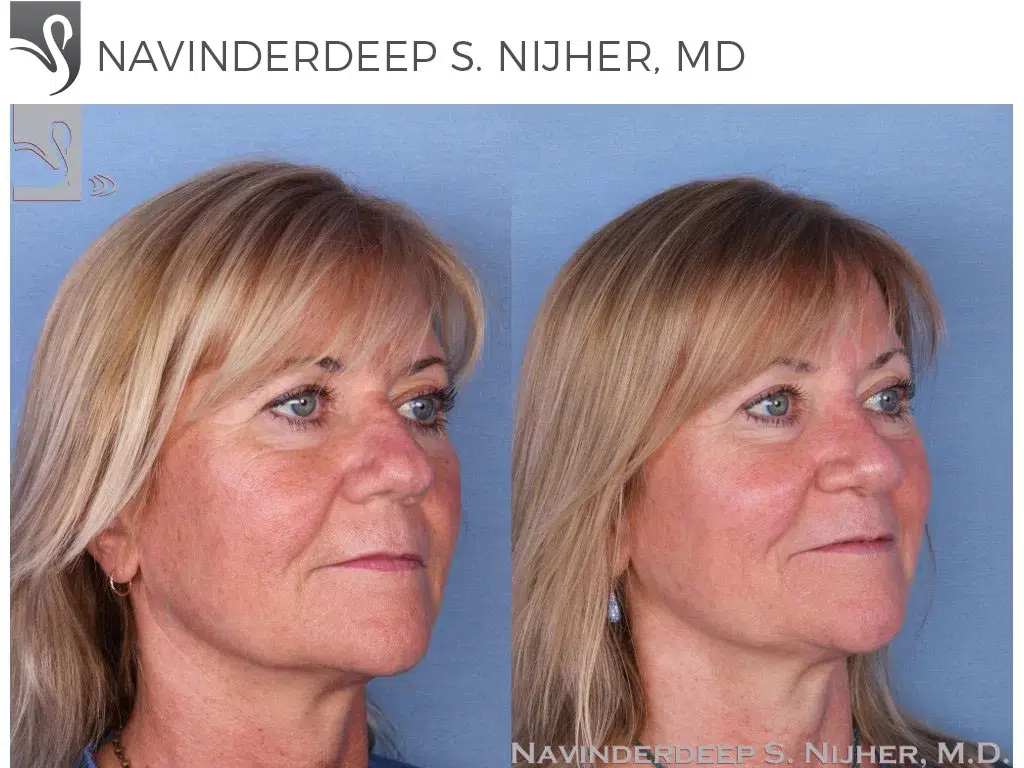 Before and After Image: Rhinoplasty Case #39808 - right-front-oblique