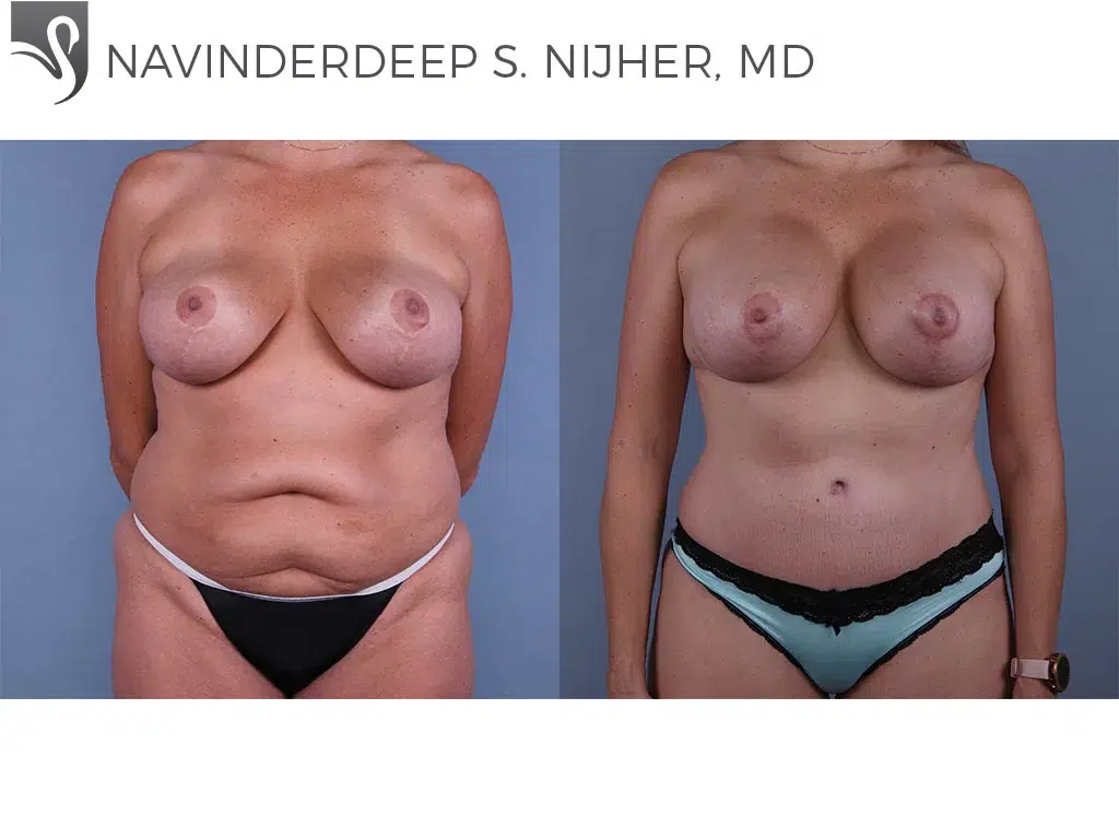 Before and After Image: Mommy Makeover Case #40095 - front