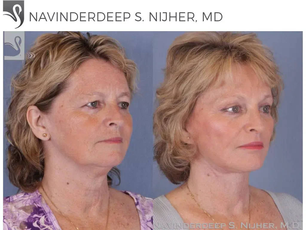 Before and After Image: Brow Lift Case #40702 - right-front-oblique