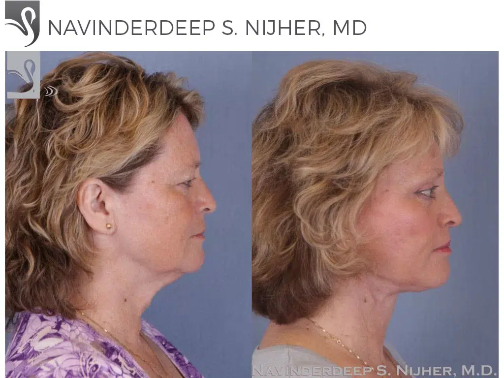 Before and After Image: Brow Lift Case #40702 - right-side