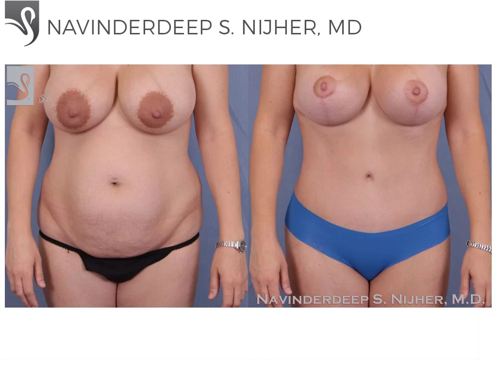 Before and After Image: Abdominoplasty (Tummy Tuck) Case #40869 - front