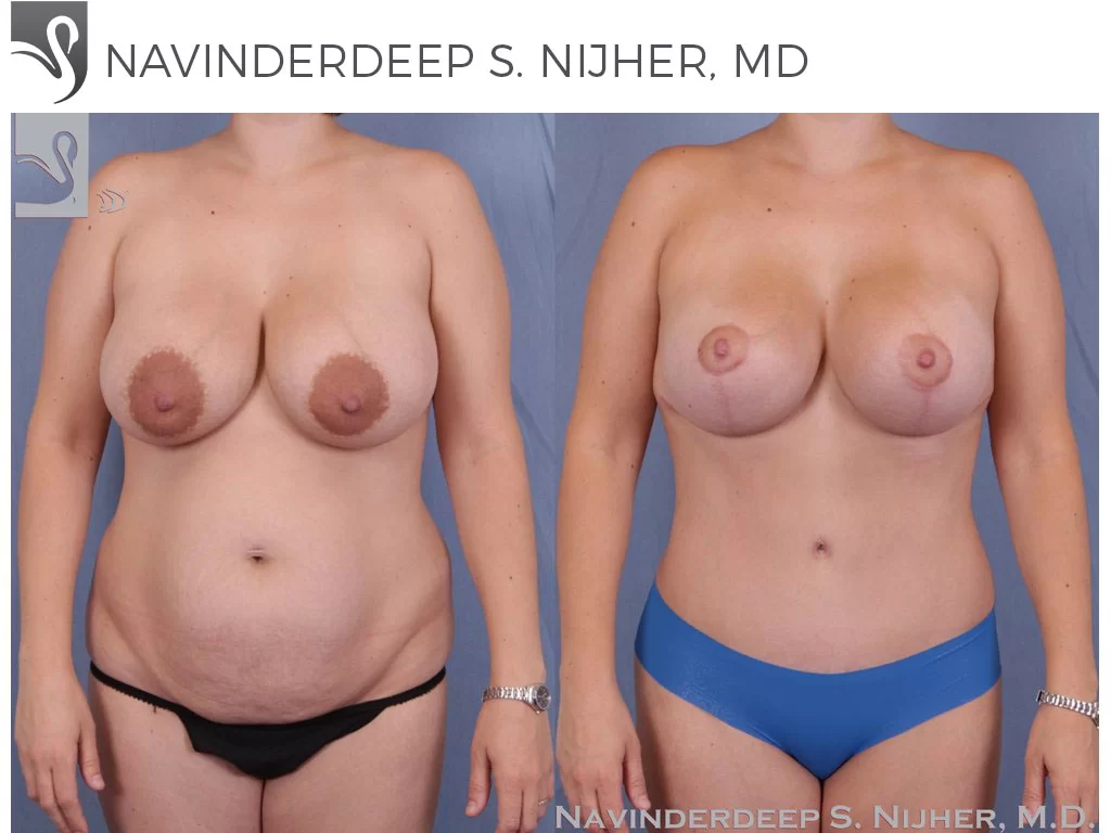 Before and After Image: Mommy Makeover Case #40869 - front