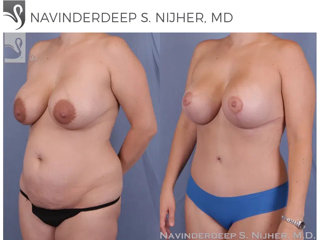 Before and After Image: Mommy Makeover Case #40869 - left-front-oblique