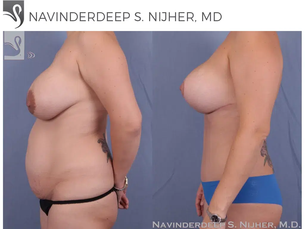 Before and After Image: Mommy Makeover Case #40869 - left-side