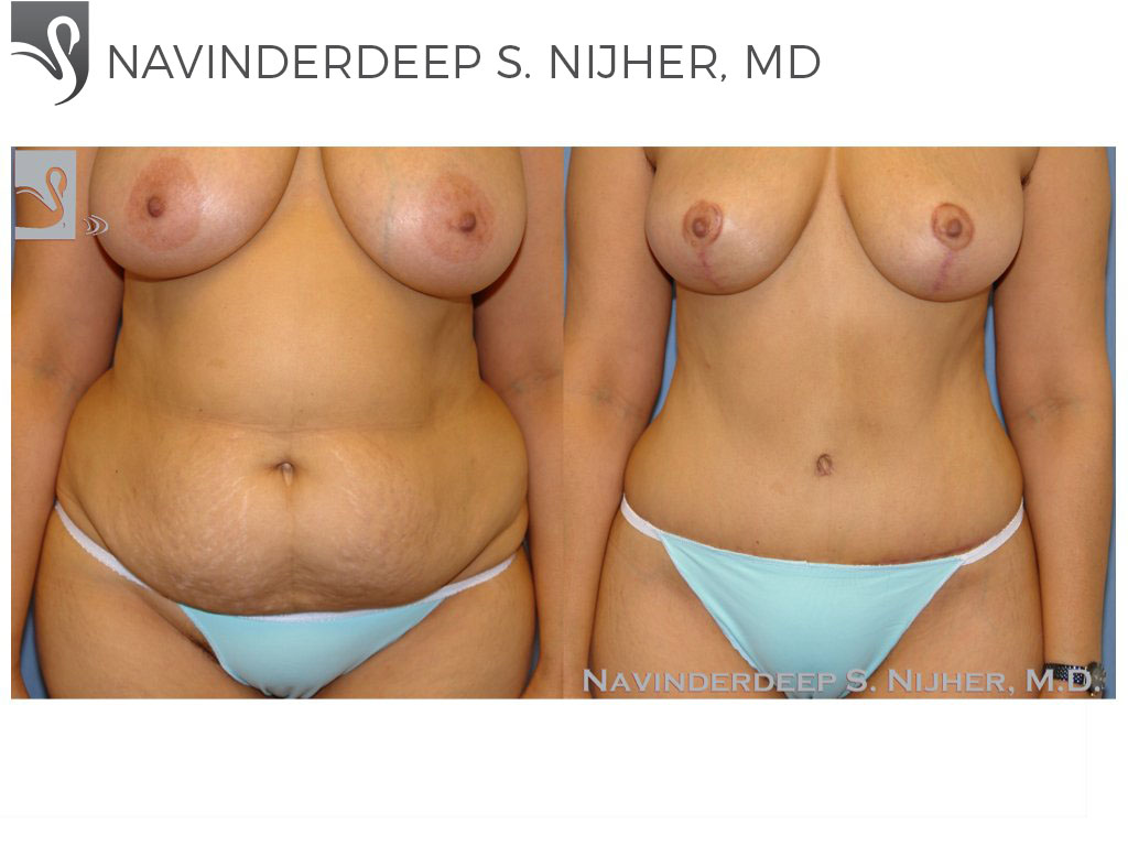 Before and After Image: Abdominoplasty (Tummy Tuck) Case #41207 - front