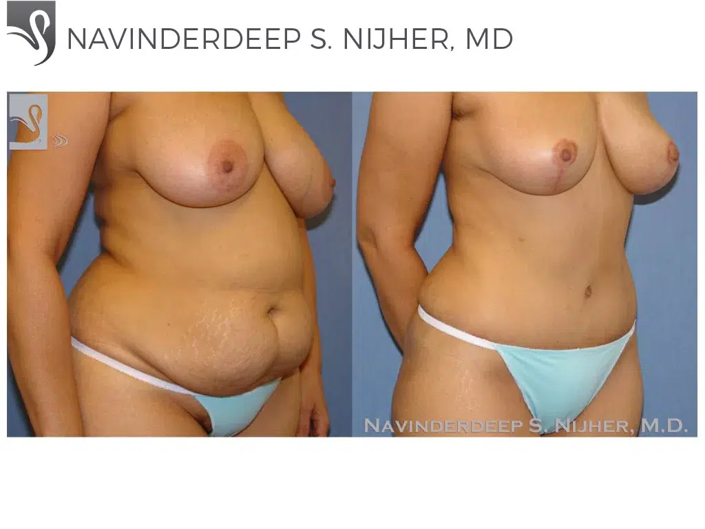Before and After Image: Abdominoplasty (Tummy Tuck) Case #41207 - right-front-oblique