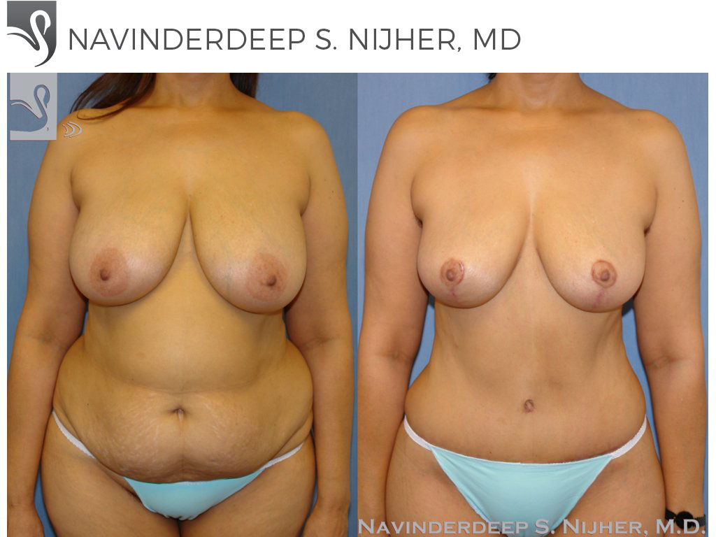 Before and After Image: Mommy Makeover Case #41207 - front