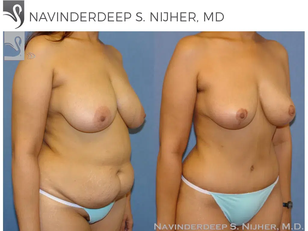 Before and After Image: Mommy Makeover Case #41207 - right-front-oblique