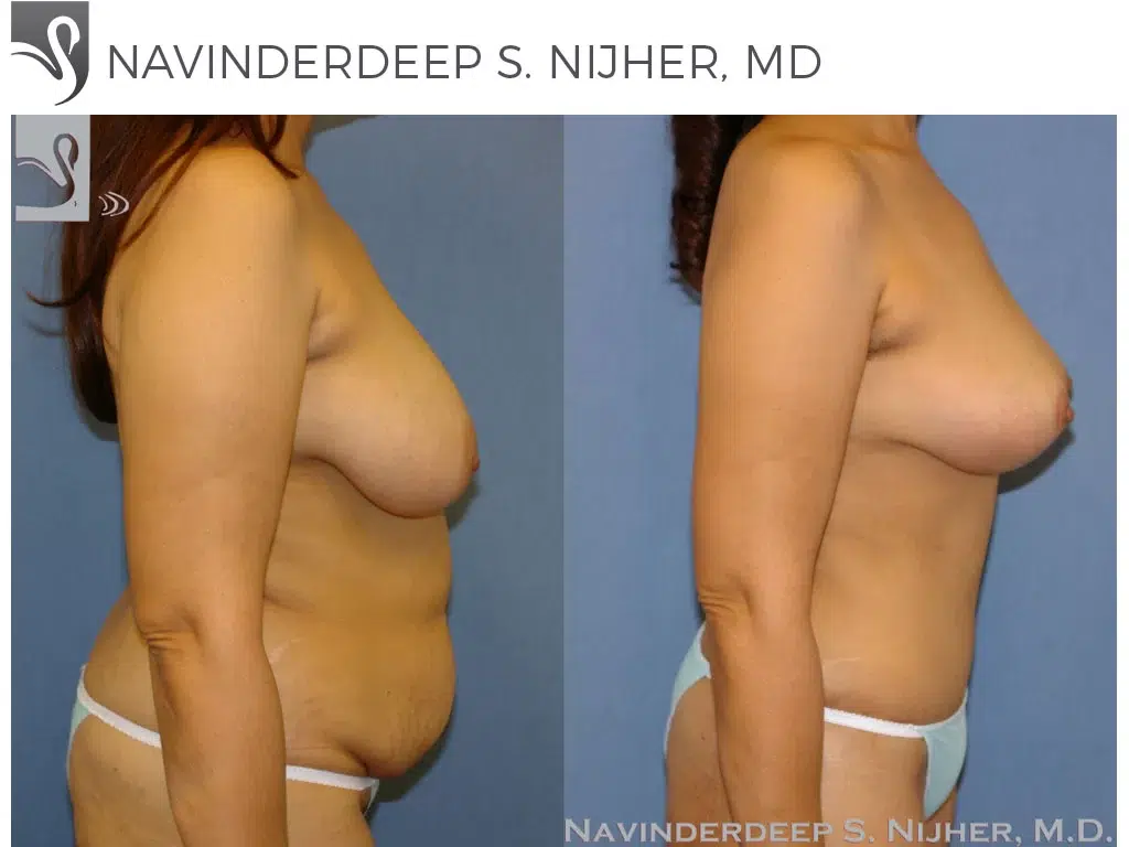 Before and After Image: Mommy Makeover Case #41207 - right-side