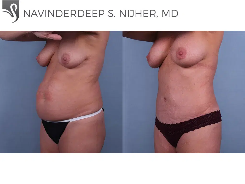 Before and After Image: Abdominoplasty (Tummy Tuck) Case #41231 - left-front-oblique