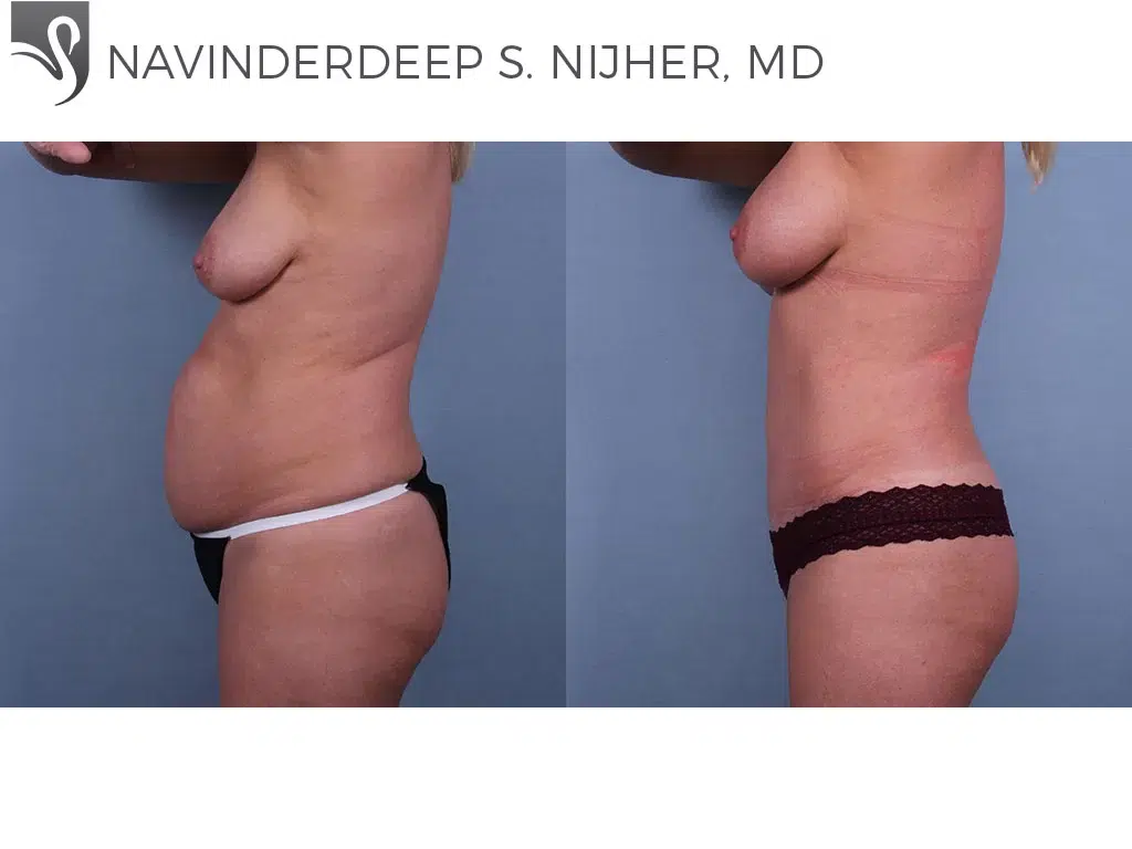 Before and After Image: Abdominoplasty (Tummy Tuck) Case #41231 - left-side