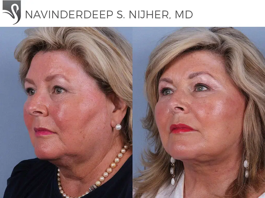 Before and After Image: Face Lift Case #41560 - left-front-oblique