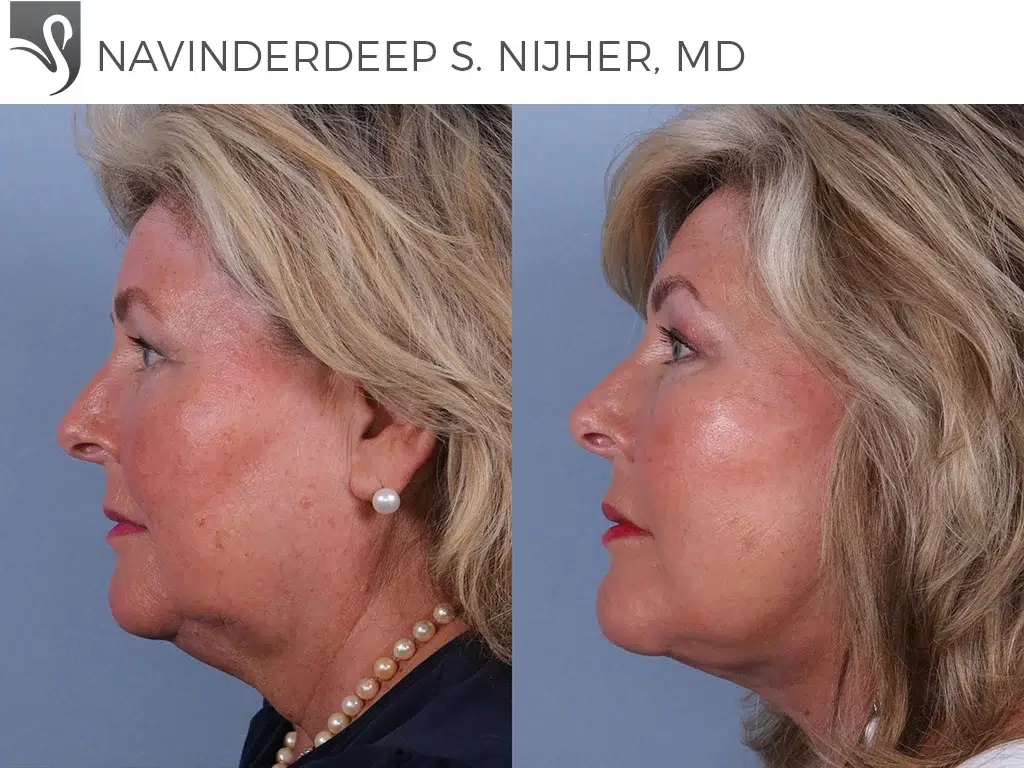 Before and After Image: Face Lift Case #41560 - left-side