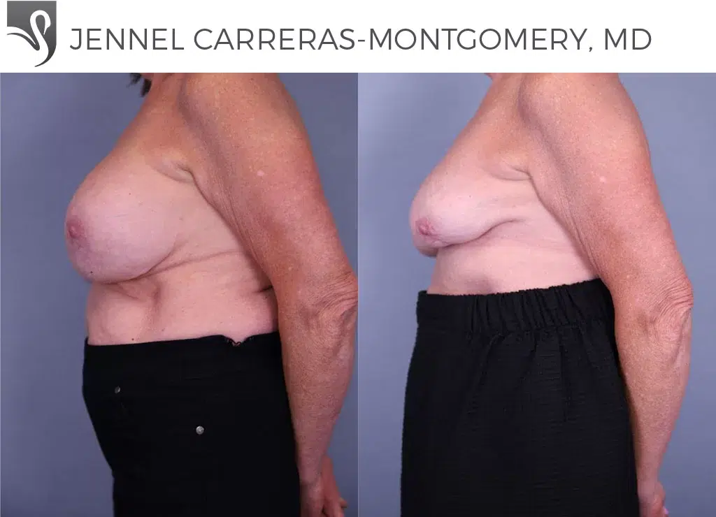 Before and After Image: Breast Revisions Case #4179 - left-side