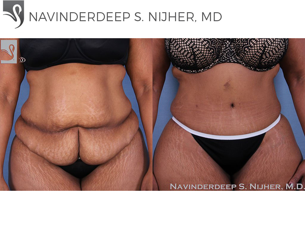 Before and After Image: Abdominoplasty (Tummy Tuck) Case #41970 - front