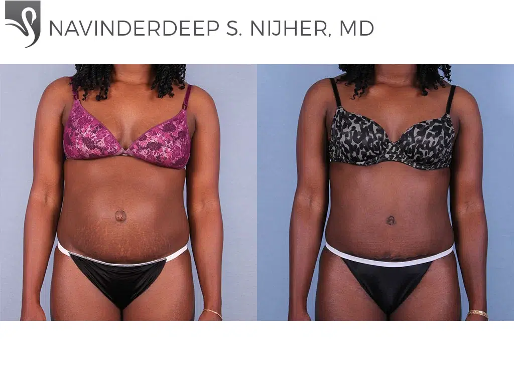Before and After Image: Abdominoplasty (Tummy Tuck) Case #42110 - front