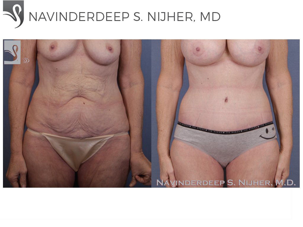 Before and After Image: Abdominoplasty (Tummy Tuck) Case #42483 - front