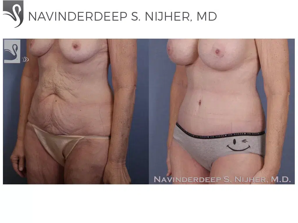 Before and After Image: Abdominoplasty (Tummy Tuck) Case #42483 - left-front-oblique