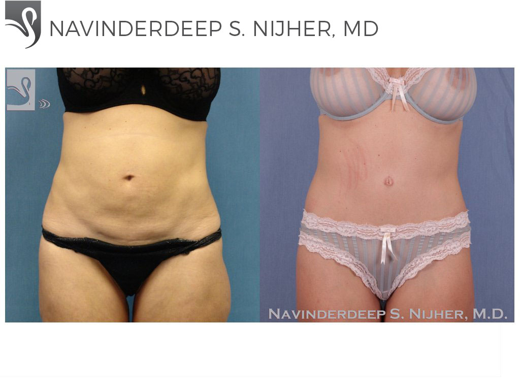 Before and After Image: Abdominoplasty (Tummy Tuck) Case #42736 - front